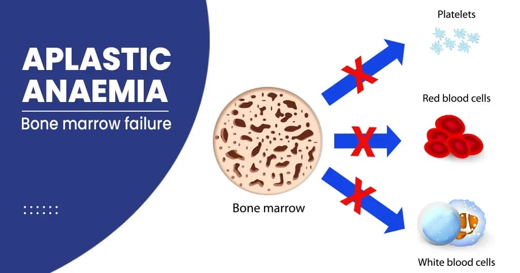 Aplastic anaemia – Symptoms, Causes, Diagnosis, and Risk factors