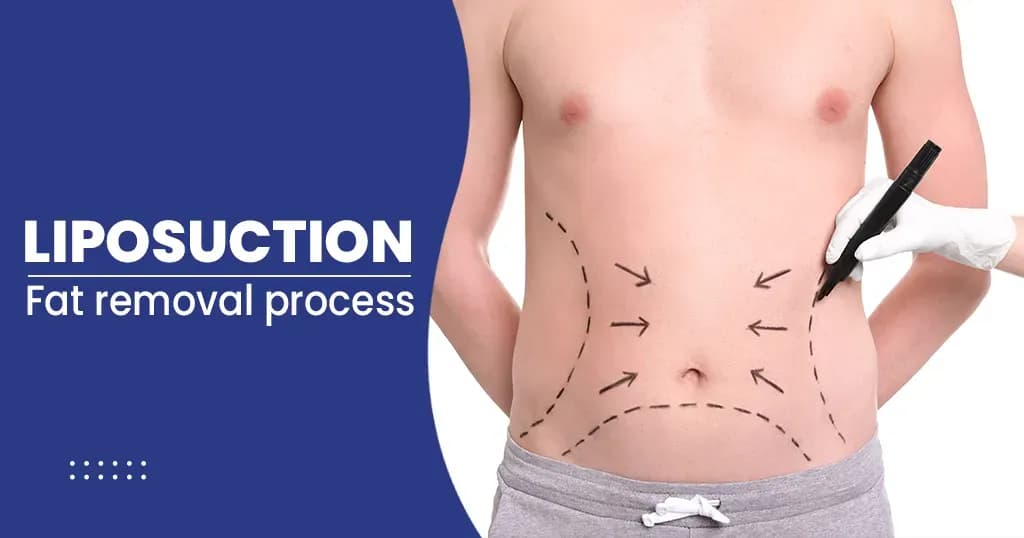 Liposuction – Types, Procedures, and Benefits