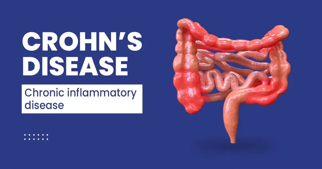 Crohn's disease – Symptoms, Diagnosis, and Complications