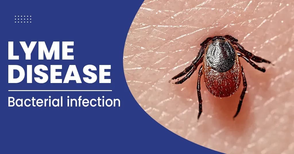 Lyme disease – Symptoms, Causes, Diagnosis, and Treatments