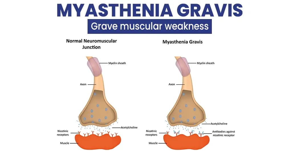 Myasthenia Gravis – Types and its Symptoms