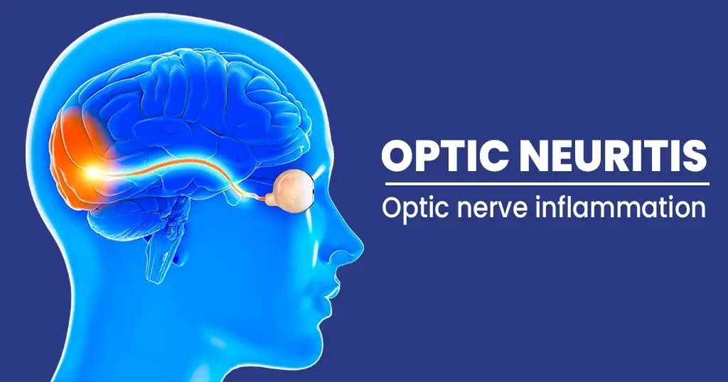 Optic neuritis – Symptoms, Causes, Diagnosis, and Preventions