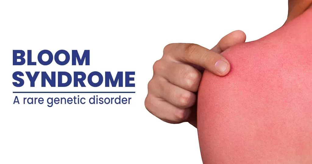 Bloom Syndrome - Symptoms, Causes, and Risk factors