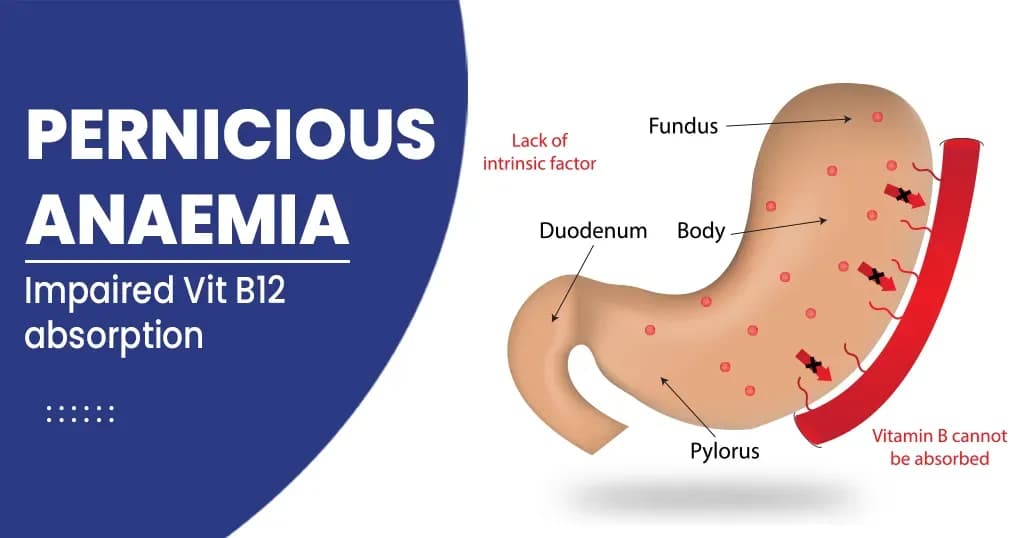 Pernicious anaemia - Symptoms, Causes, Diagnosis, and Treatments