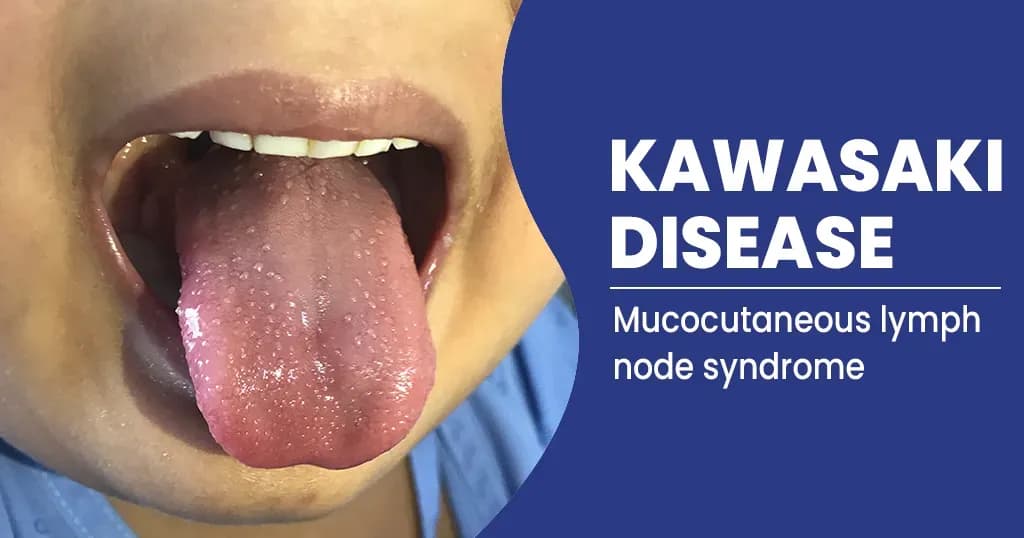 Kawasaki Disease – Symptoms, Diagnosis, Treatment, and Complications