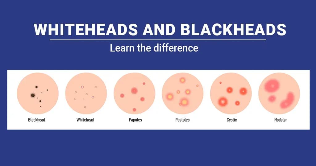 5 Methods to treat whiteheads and blackheads