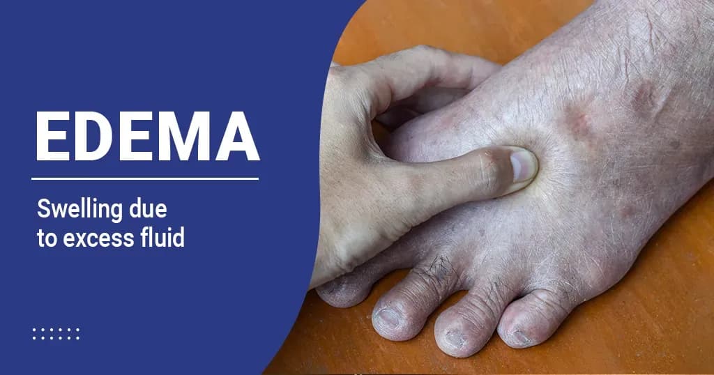 Edema – Symptoms, Causes & treatment