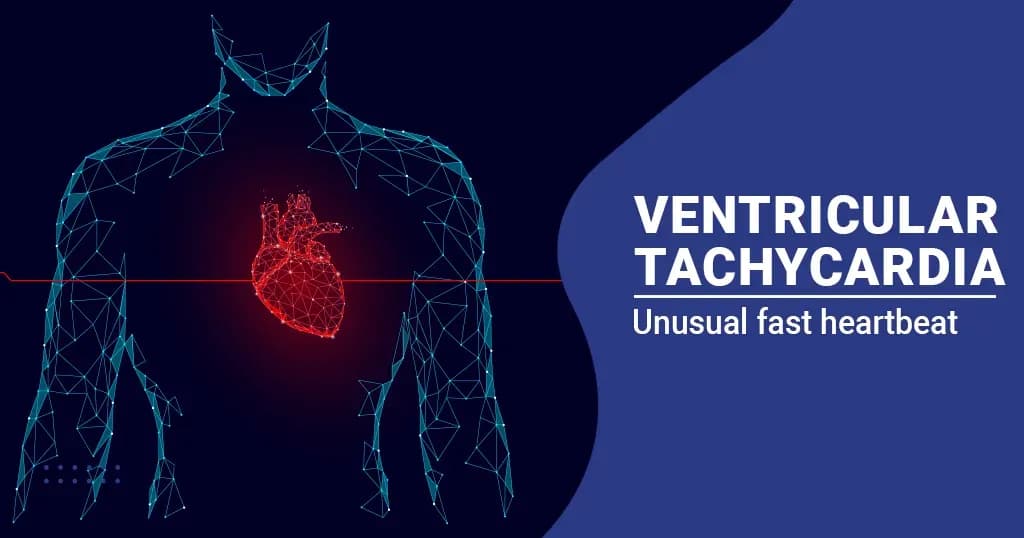 Ventricular Tachycardia – Causes, Symptoms and Treatment