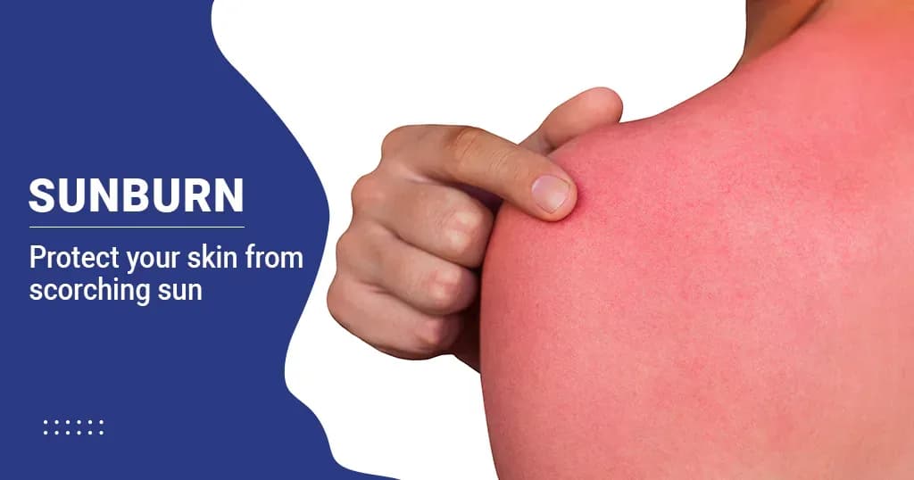 Sunburn - Causes, Symptoms and Treatment