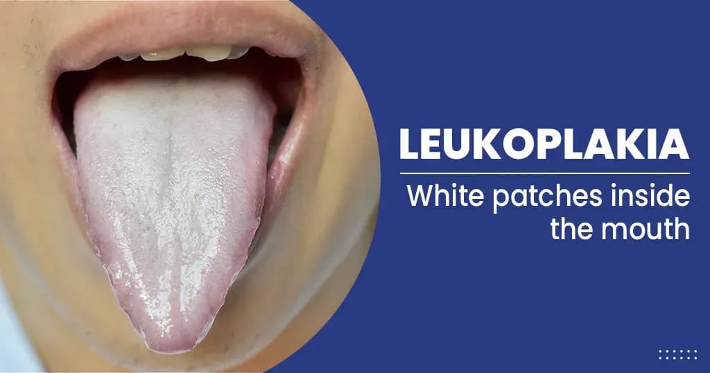 Leukoplakia- causes, symptoms, treatments, preventions and more