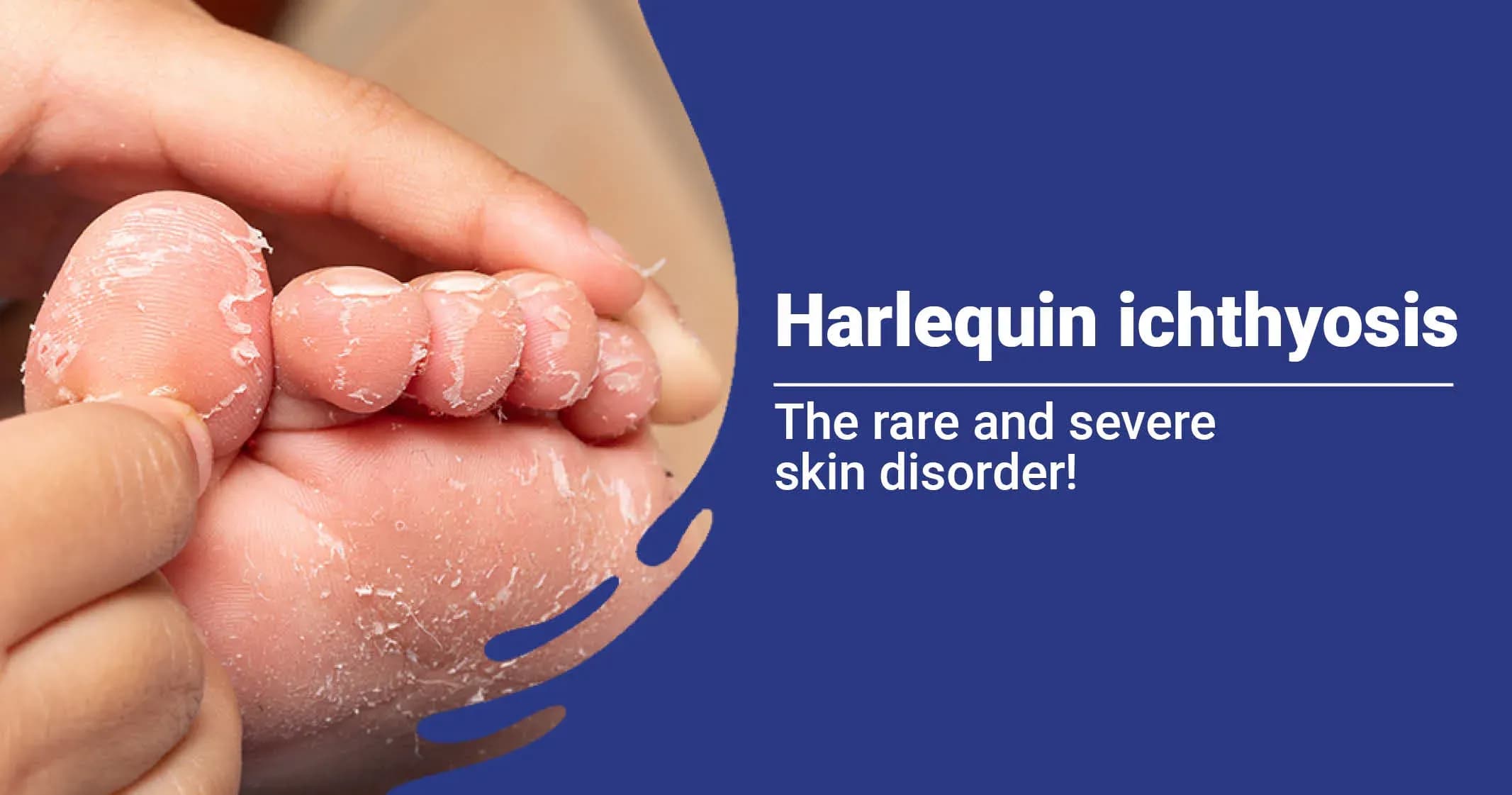 Harlequin Ichthyosis - Symptoms, Causes, Test, And Treatments