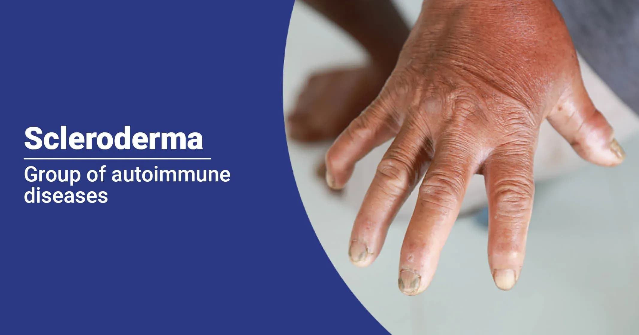 Scleroderma – Types, Symptoms & causes