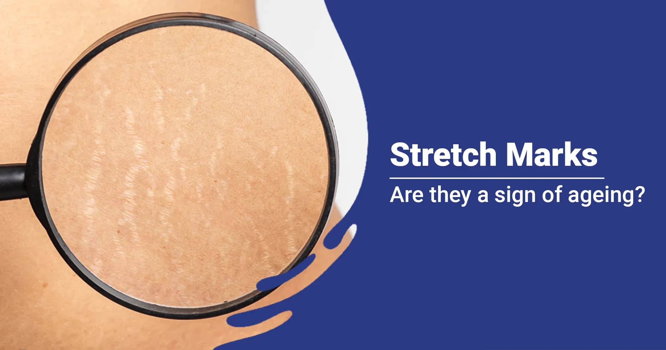 Stretch Marks: Causes, Treatment and Prevention