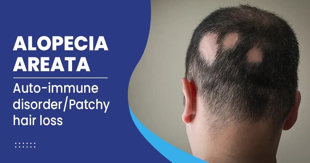 What do you need to know about Alopecia areata?