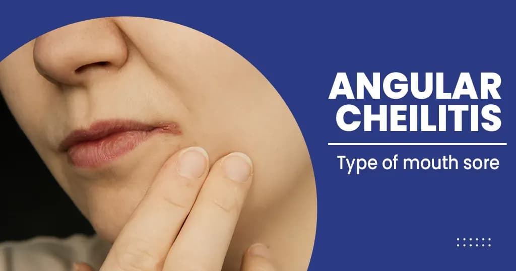 Angular cheilitis - symptoms, treatments, and more