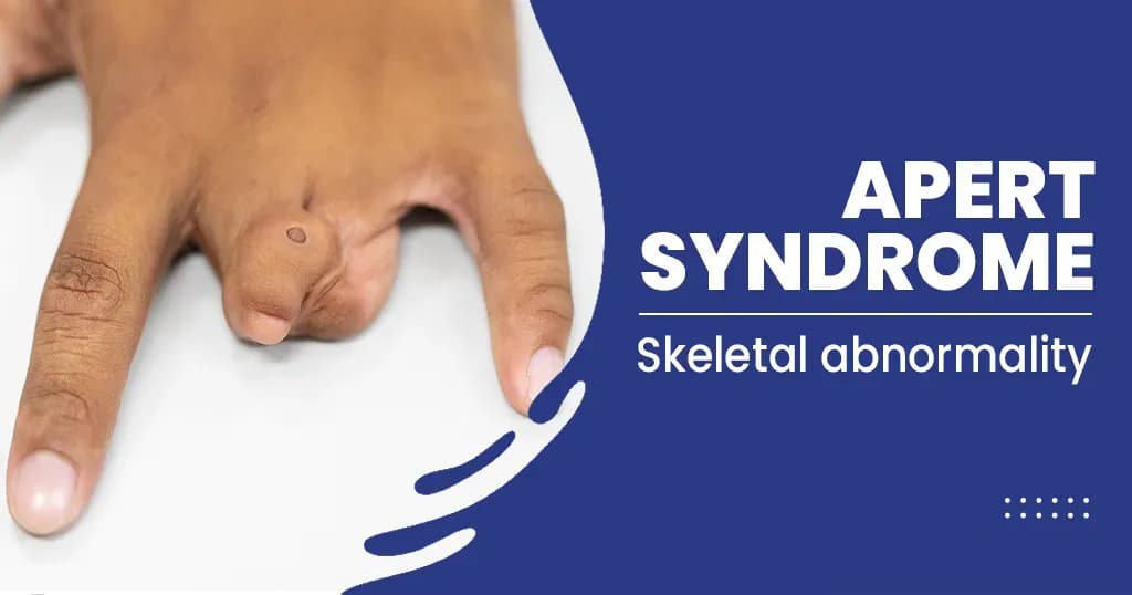 Apert syndrome – Symptoms and Causes- Treatments-more