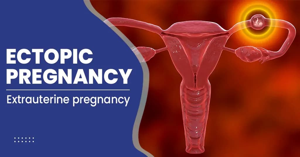 Ectopic Pregnancy - What to know?