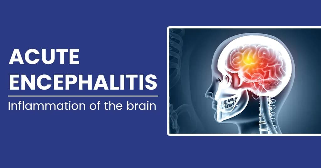 Acute encephalitis - Causes, Symptoms, Diagnosis and Treatments