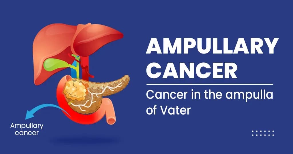 Ampullary cancer – Causes, Symptoms, Treatment and Risk factors