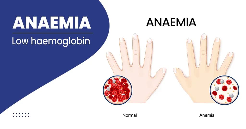 Anaemia - Types, Symptoms, Causes and Treatments