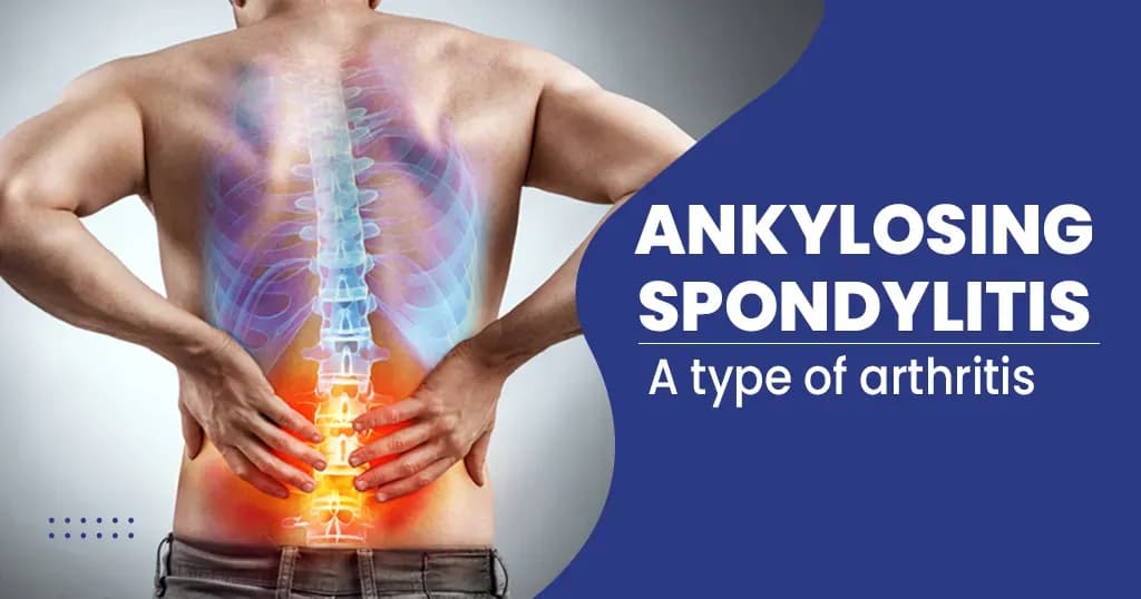 What Is Ankylosing spondylitis - Symptoms, Causes, Treatment, and Prevention