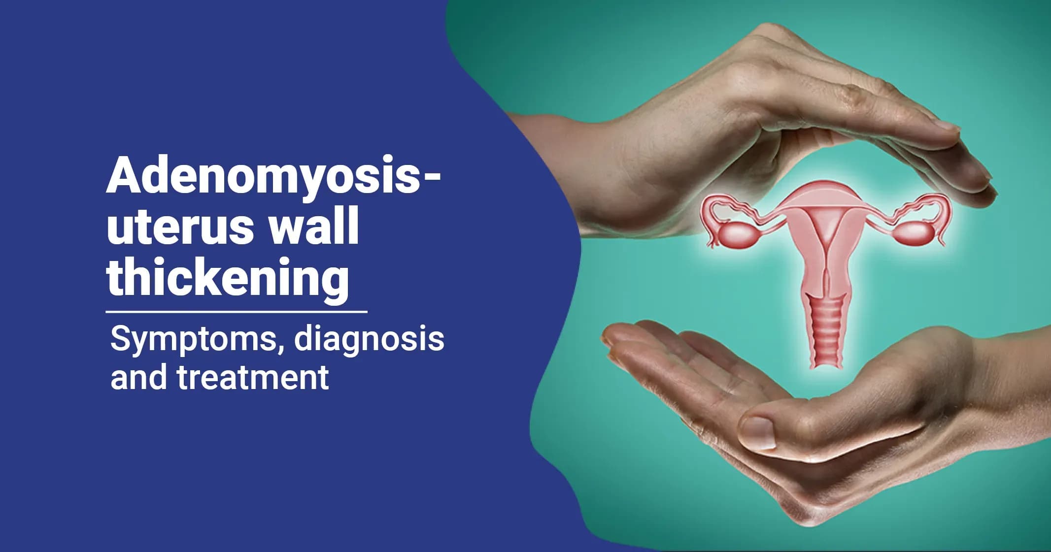 Adenomyosis: Symptoms, Diagnosis, and Treatment