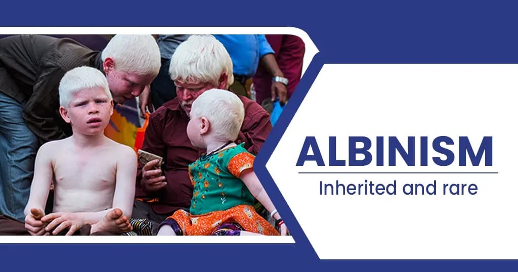 Albinism - Causes, Symptoms and Treatment