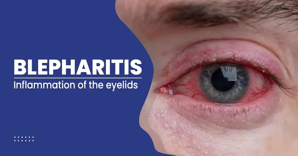 Blepharitis – Symptoms, Causes, Treatment, And Prevention