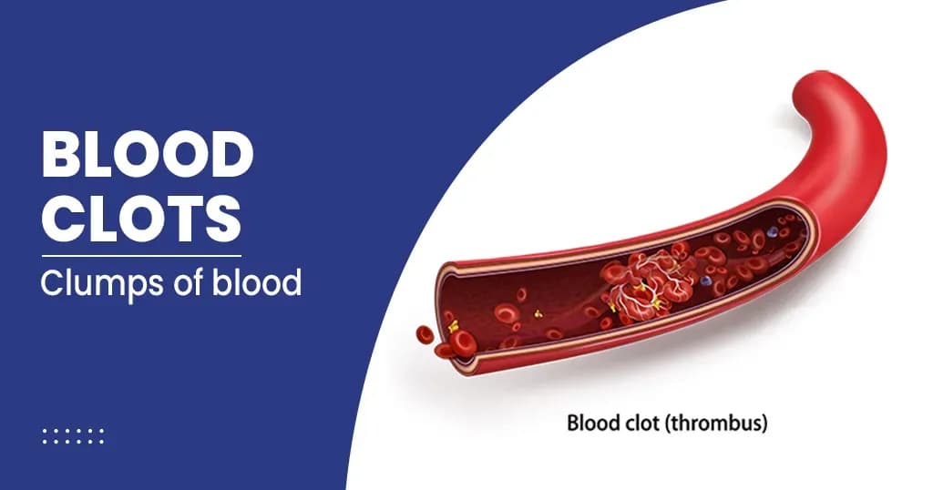 Blood Clot Symptoms, Causes and Treatments