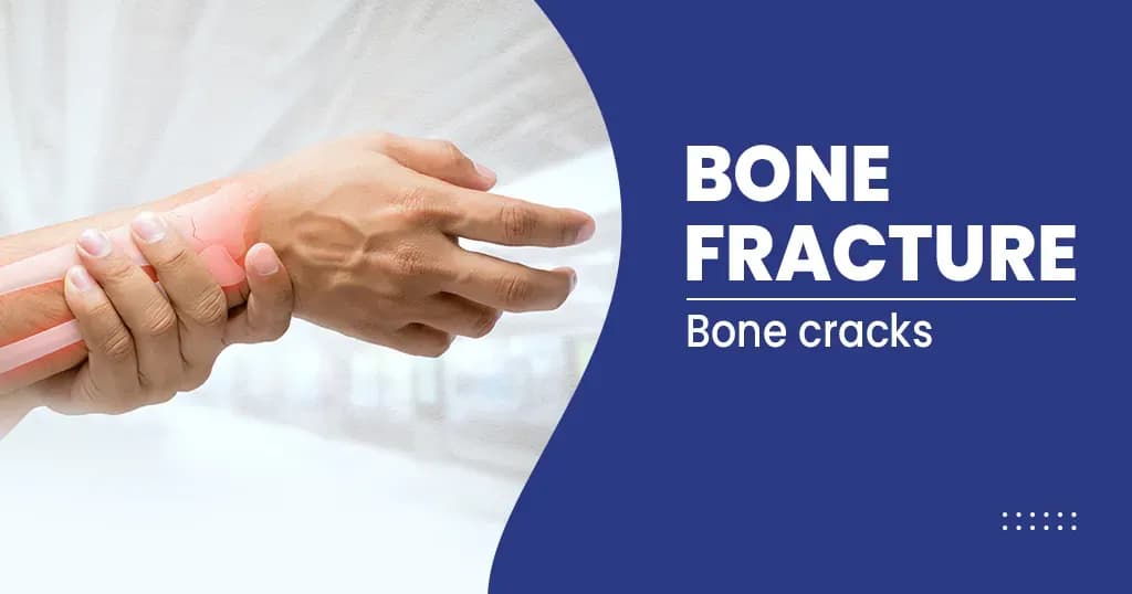 Bone Fracture – Types, Symptoms, Causes, Complications and more