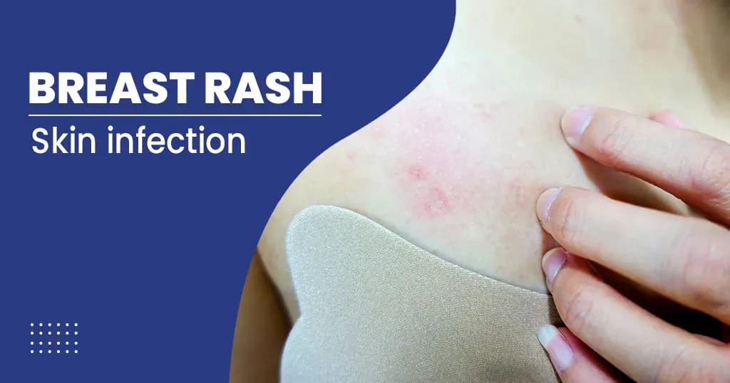 Breast Rashes Causes, Symptoms and Treatments 