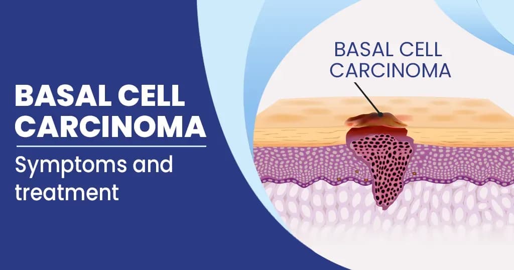 Basal Cell Carcinoma Symptoms, Causes, Diagnosis and Treatment