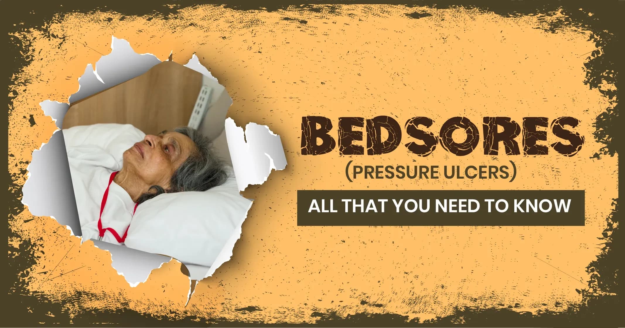 Bedsores (Pressure sores) - Treatment and stages 