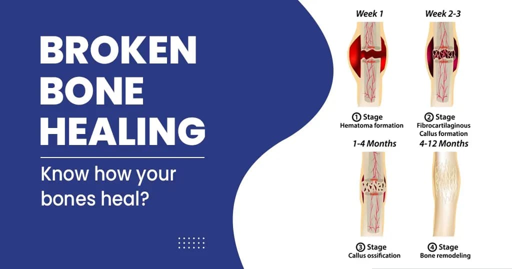 How Broken Bones Heal