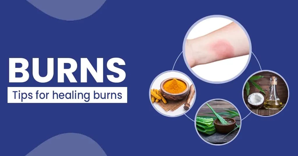 Treatment for burns Home remedies