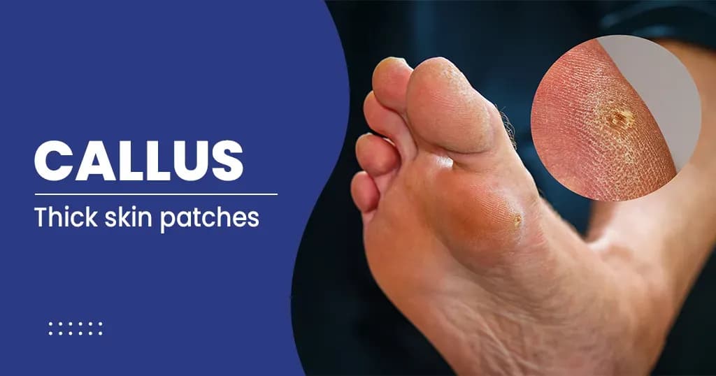 Definition of Callus – Causes, Symptoms, Treatment, and Prevention