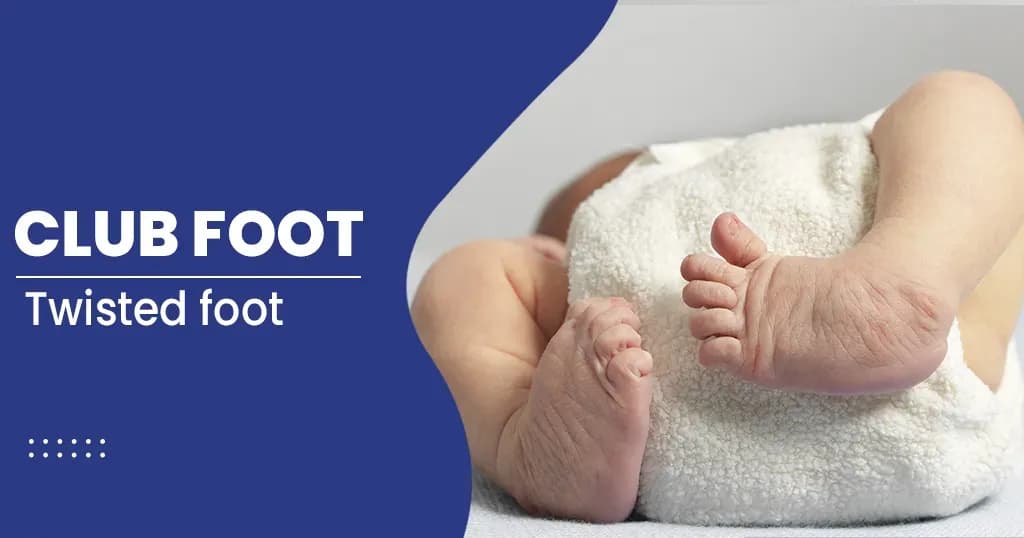 Club Foot  - Types, Risk factors, Symptoms, and Treatments