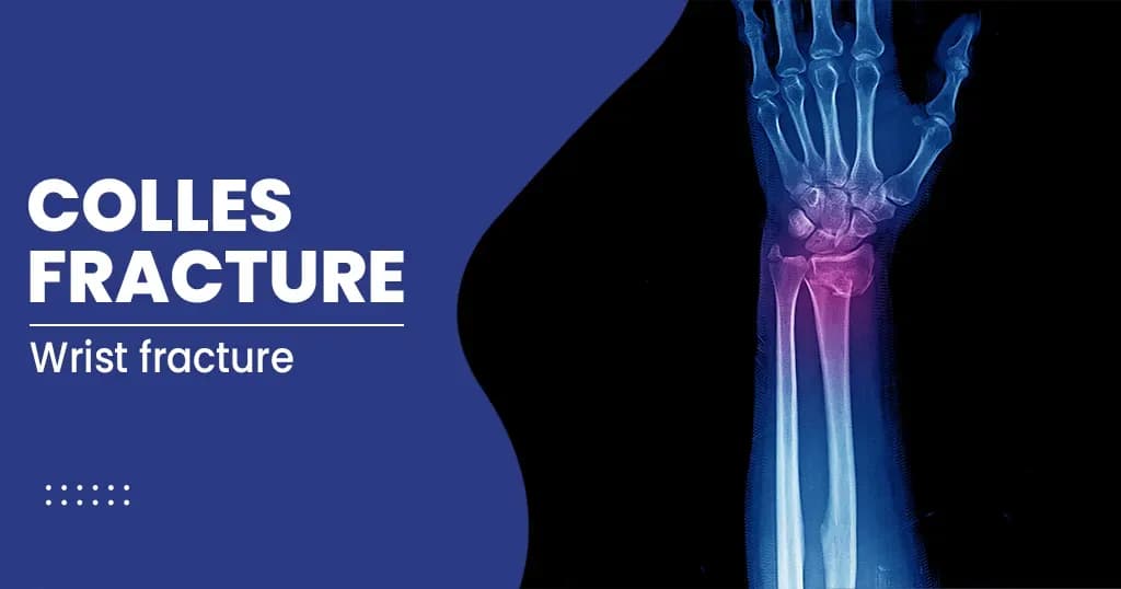 Colles Fracture - Types, Symptoms, and Treatments