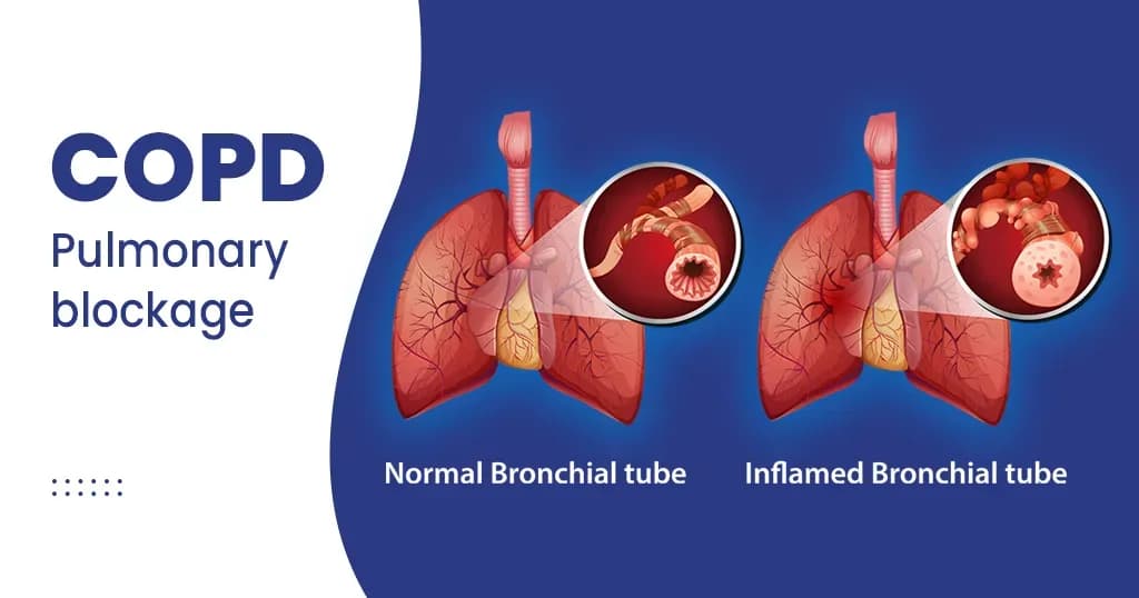 World COPD Day: Raising Awareness and Advocating for Lung Health