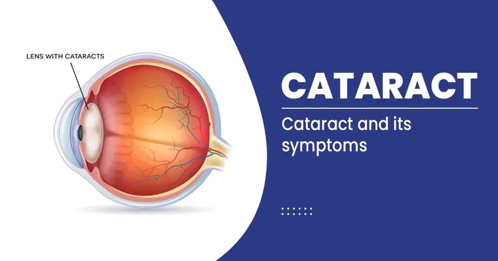 Cataract