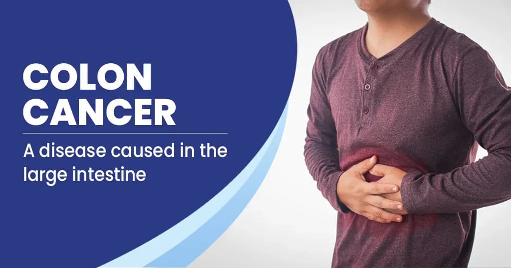 Colon cancer- Symptoms, causes, stages and treatment