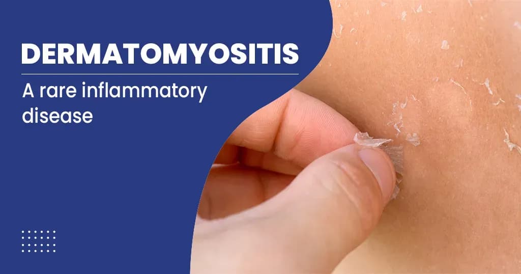 Dermatomyositis - Causes, Diagnosis and Treatment