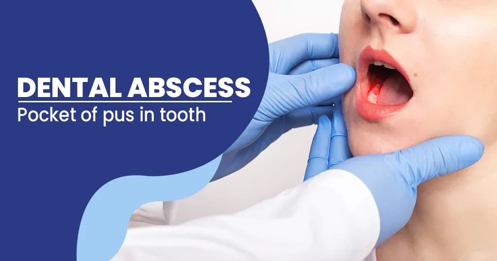 Dental abscess - Symptoms, Causes, and Treatments