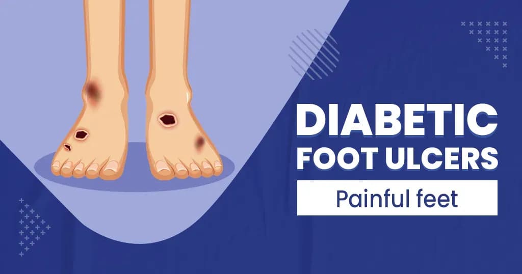 What is Diabetic foot ulcers - Symptoms, Causes, Risk factors, and Prevention