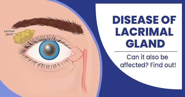 Disease of lacrimal gland