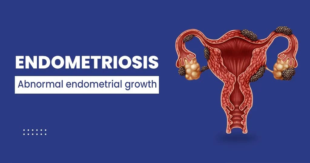 Endometriosis – Signs and Symptoms, Diagnosis, Treatments