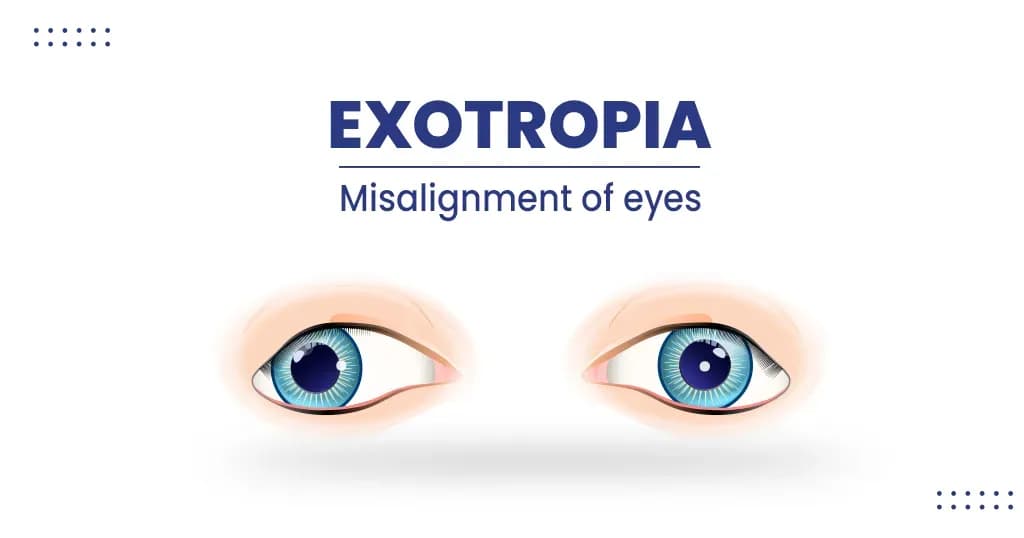 Exotropia – Types, Symptoms, Diagnosis, and Risk factors