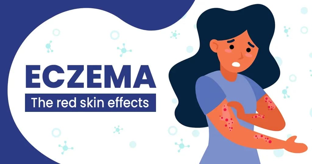 Eczema - Symptoms, Causes and treatment