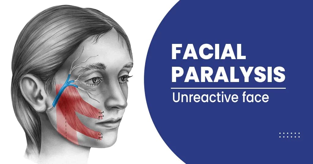 What is facial paralysis? - Symptoms, Causes, Treatments, and More