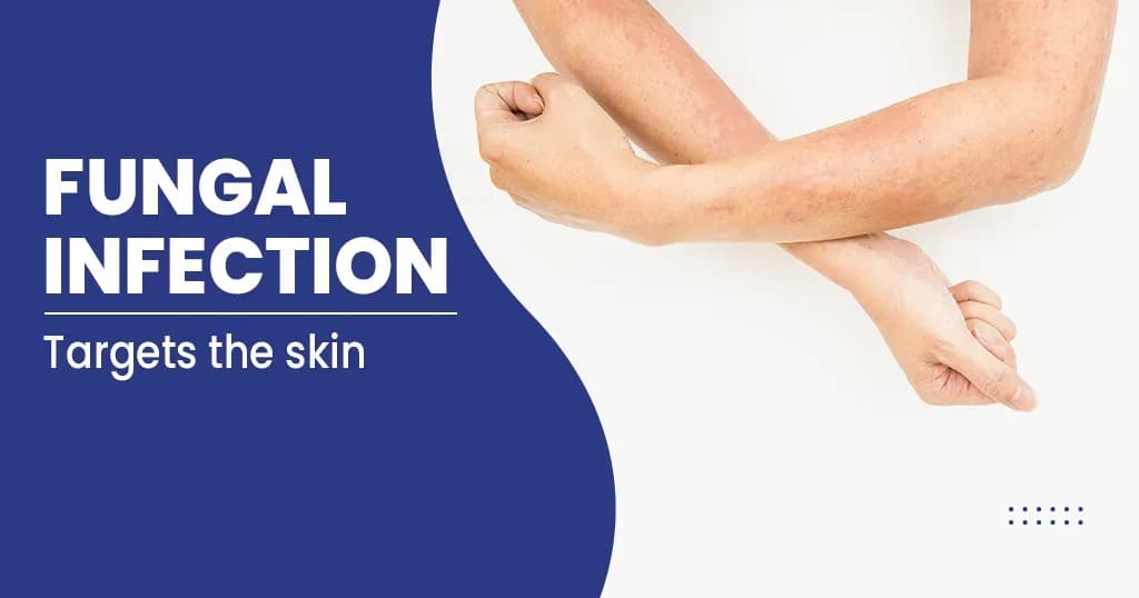 Fungal Infection - Causes , Symptoms, Treatments, and Prevention